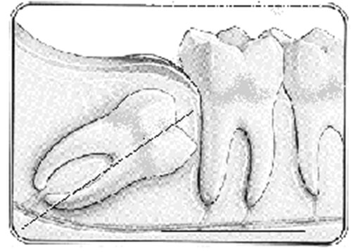 Gráfico 7 Angulación entre el tercer molar y plano mandibular. Tomado de Quirós-Palma