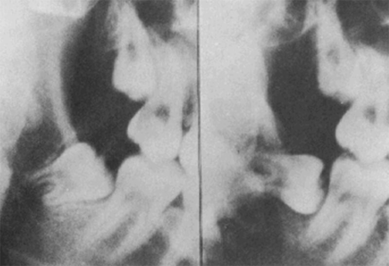 Gráfico 9 Cambios negativos en la angulación del tercer molar inferior Tomado de Richardson. 1992.