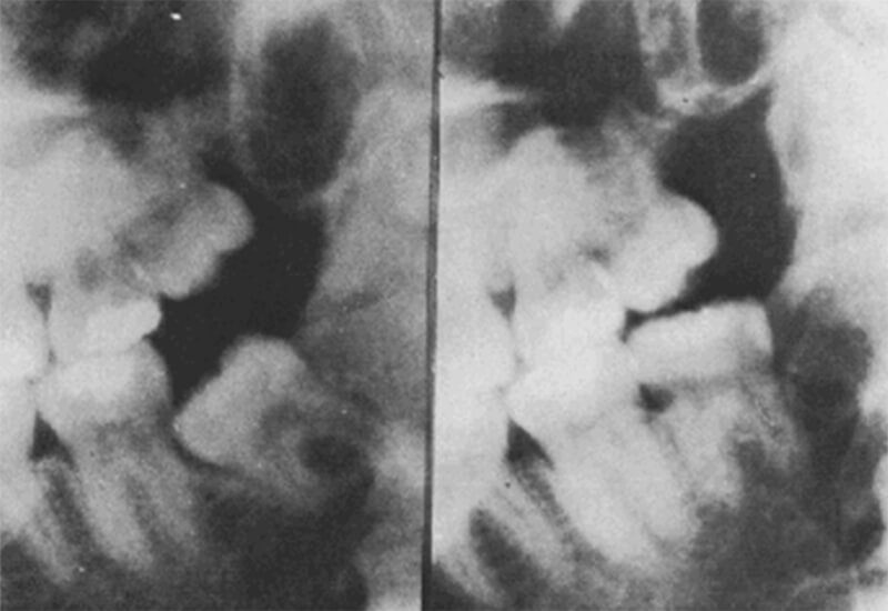 Gráfico 10 Tercer molar mandibular con cambios positivos en lo que respecta a su angulación mesiodistal. Tomado de Richardson 1992.