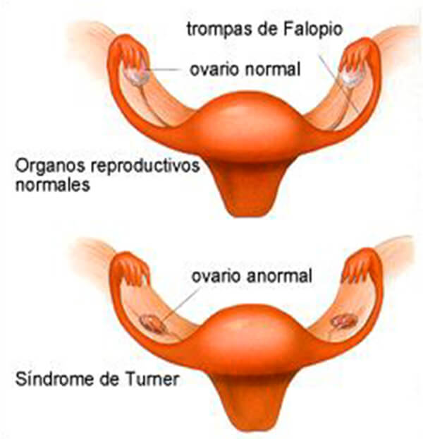 Imagen N.1 Disgenesia ovarica