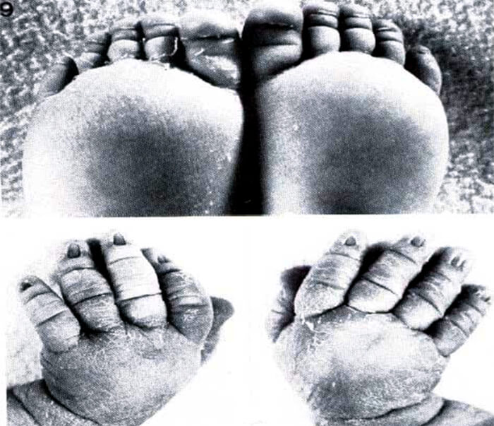 Imagen N. 2 Linfedema de manos y pies