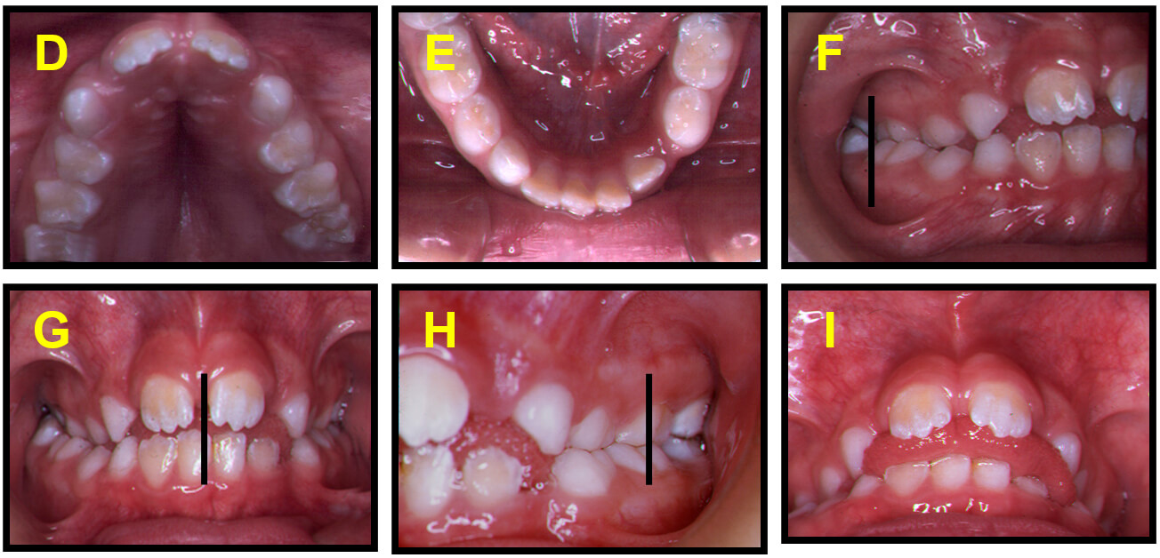 FOTOS INTRAORALES (INICIALES): Maxilar superior D, Max. Inferior E, Oclusión lado derecho F, oclusión de frente G, Oclusión lado Izquierdo H, Oberjet de 5 mm I.