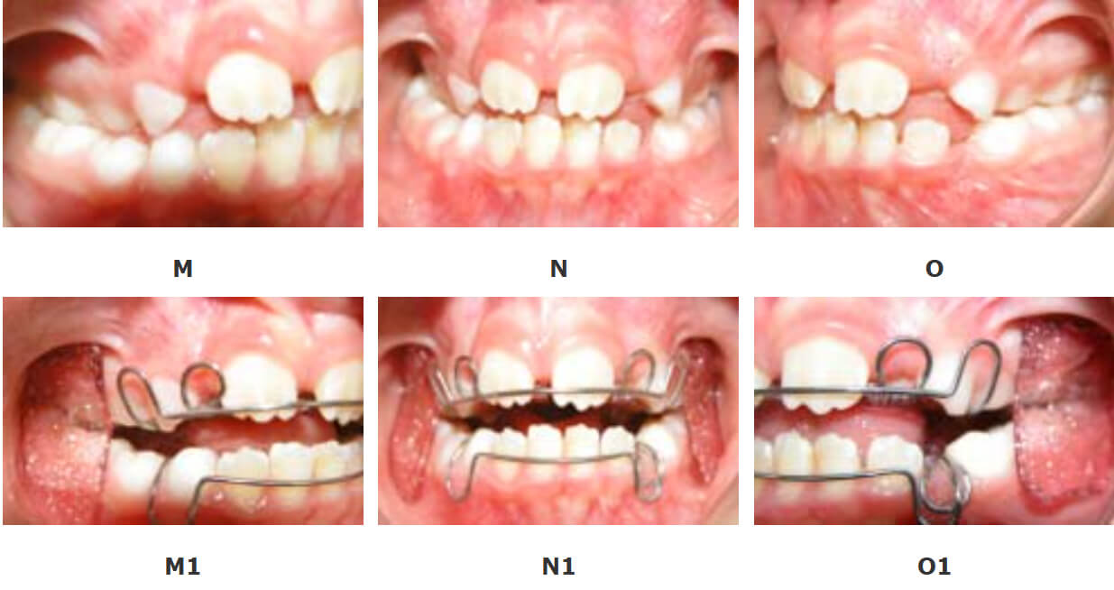 FOTOGRAFÍAS DE PRIMER CONTROL: Oclusión lado derecho con aparatología M, Oclusión de frente con aparatología N, Oclusión lado Izquierdo con aparatología O, CON APARATOS: M1, N1, O1.