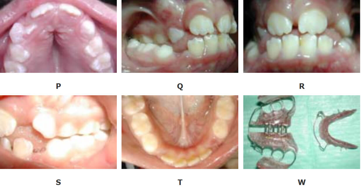 FOTOGRAFIAS SEGUNDO CONTROL: Maxilar superior P, Oclusión lado derecho Q, oclusión de frente R, Oclusión lado Izquierdo S, Max. Inferior T, Segunda Aparatología W.