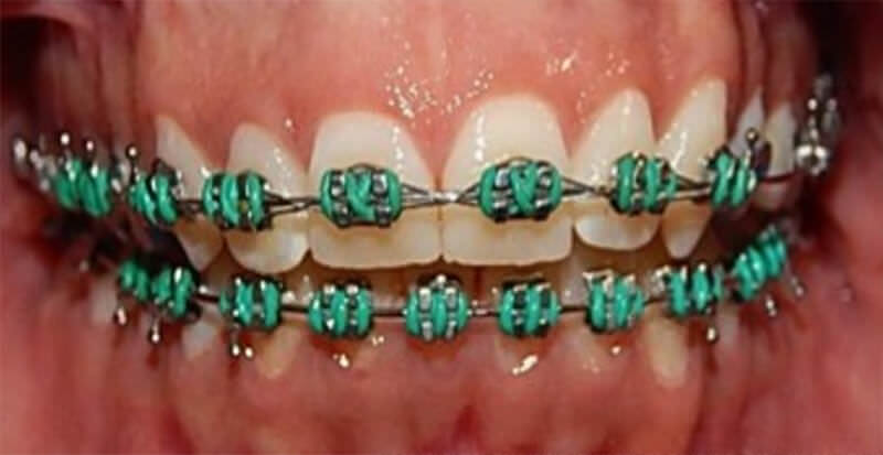 Fig.10 intraoral lateral derecha, izquierda y la de frente