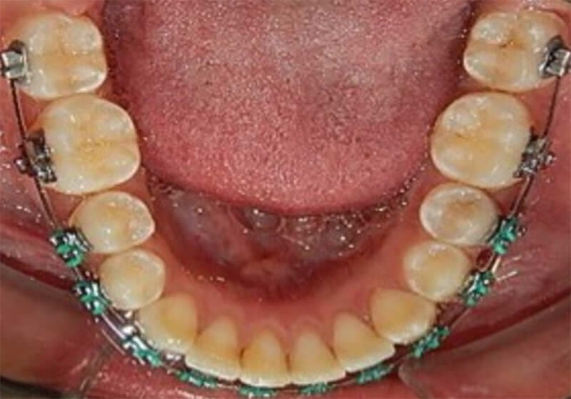 Fig. 11 vista oclusal de las arcadas superior e inferior