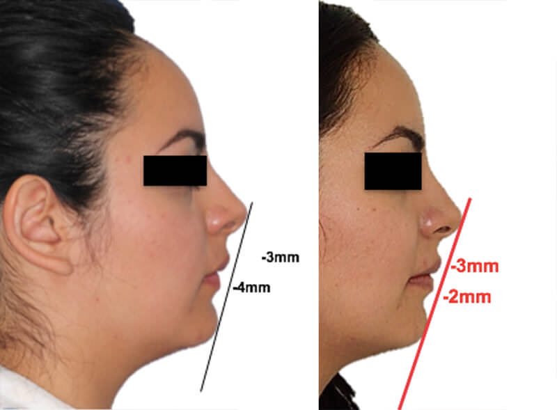 Fig. 13 inicio final de perfil