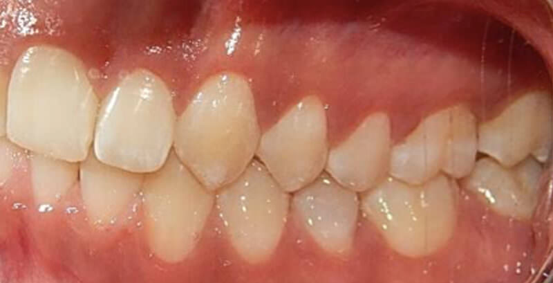 Fig. 18 comparación inicio y final intraoral lateral izquierda