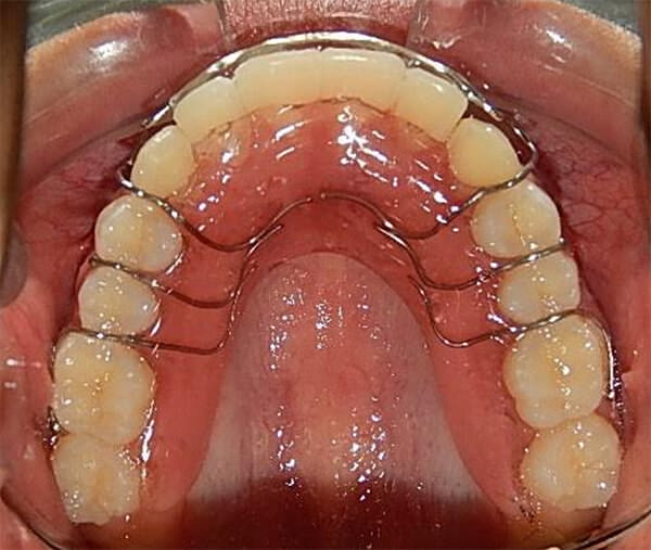 7Fig 24. Retenedor circunferencial superior con cinturón vestibular