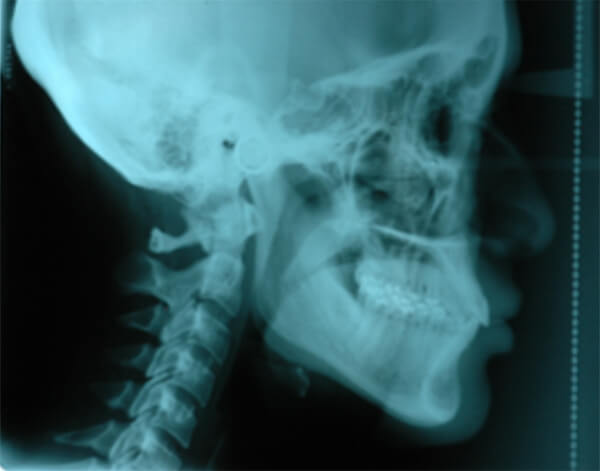 Figura 4. Radiografía lateral de cráneo