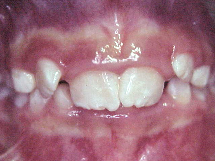 Figura 3. Mordida profunda anterior.
