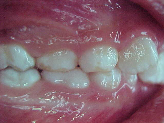 Fig. 4 Oclusal derecha inicial