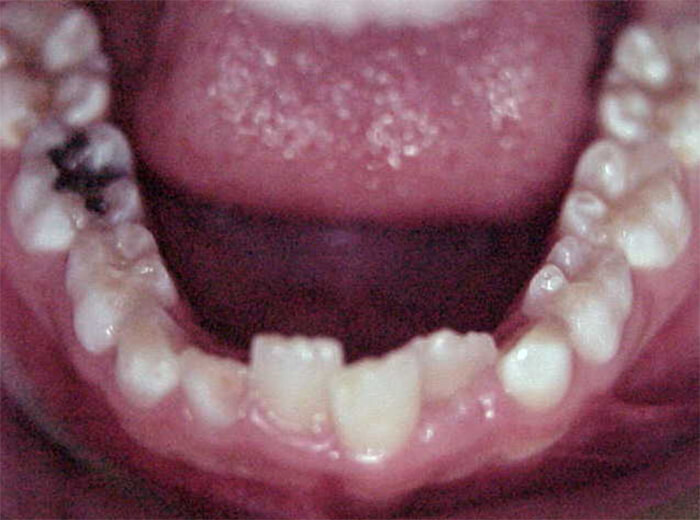 Fig. 7 Oclusal inferior inicial