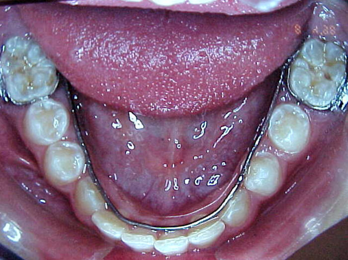 Fig. 13 Anclaje inferior