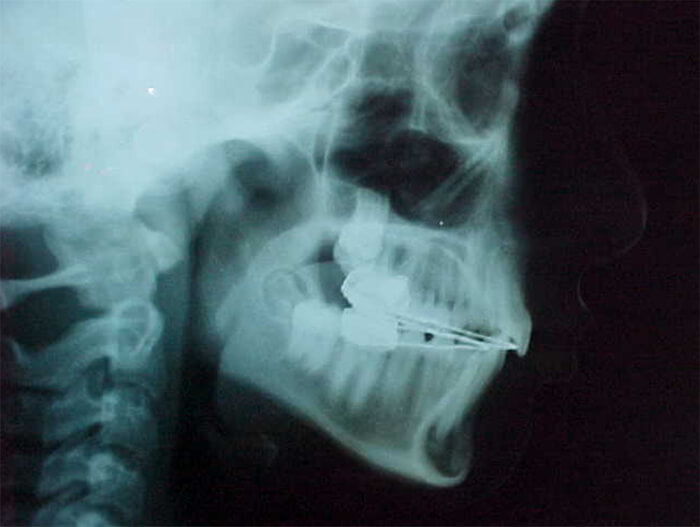 Fig. 15 Radiografía lateral de cráneo intermedia