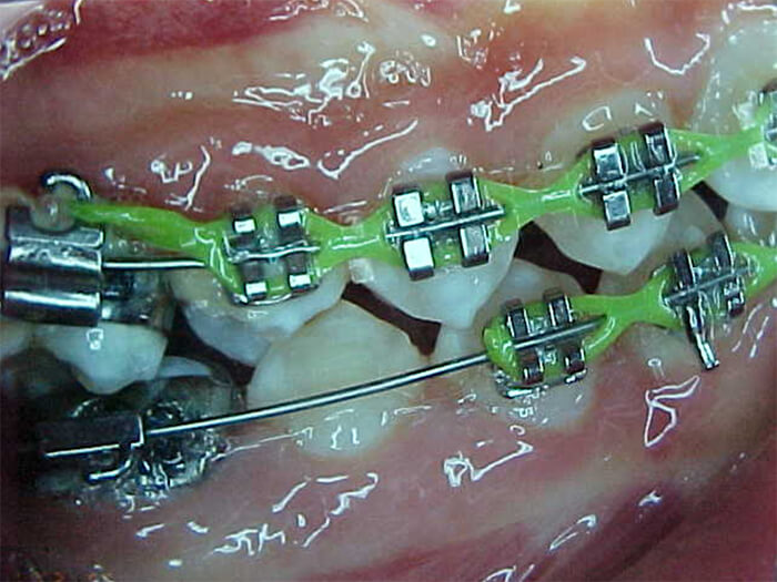 Fig. 17 Lateral derecha intermedia