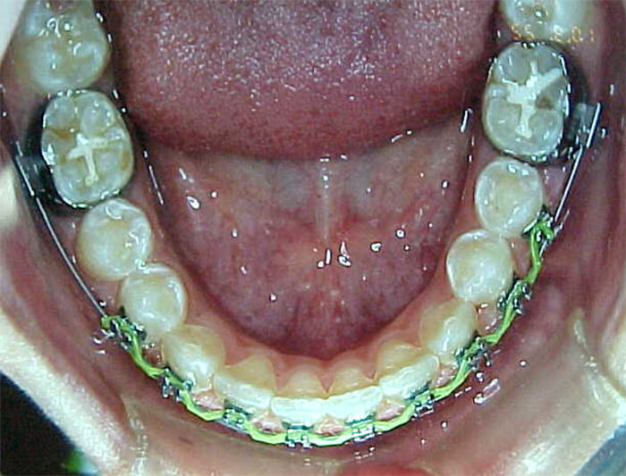 Fig. 20 Oclusal inferior intermedia
