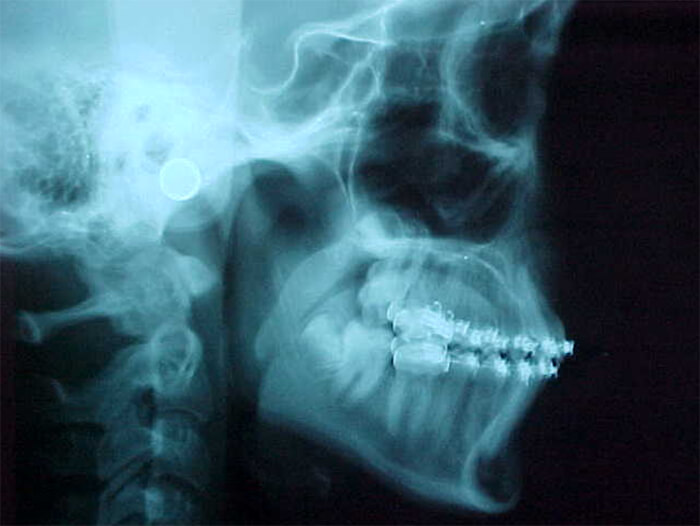 Fig. 22 Radiografía lateral de cráneo intermedia