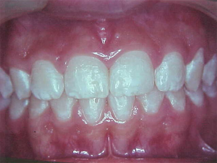 Fig. 25 Frontal final