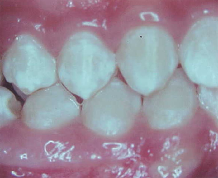 Fig. 26 Oclusal derecha final