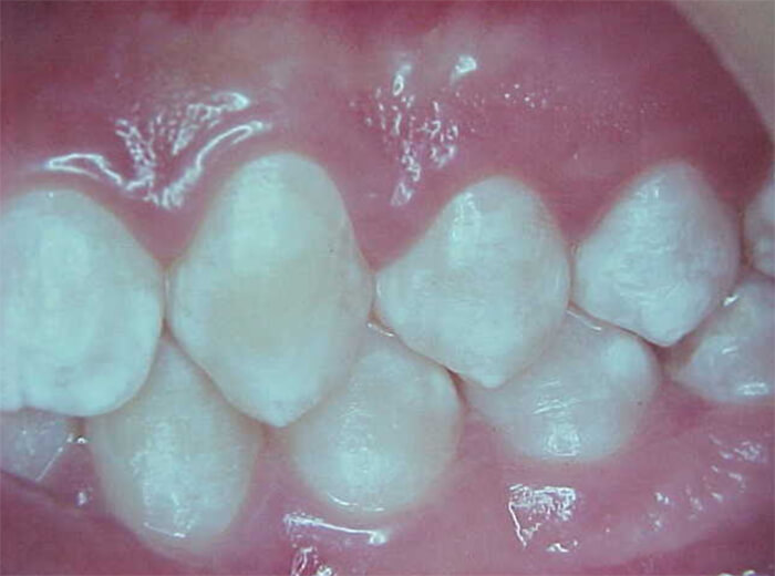 Fig. 27 Oclusal izquierda final