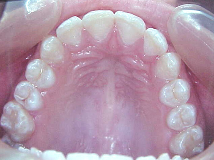Fig. 28 Oclusal superior final