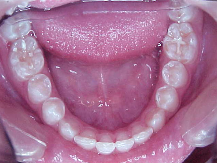 Fig. 29 Oclusal inferior fina