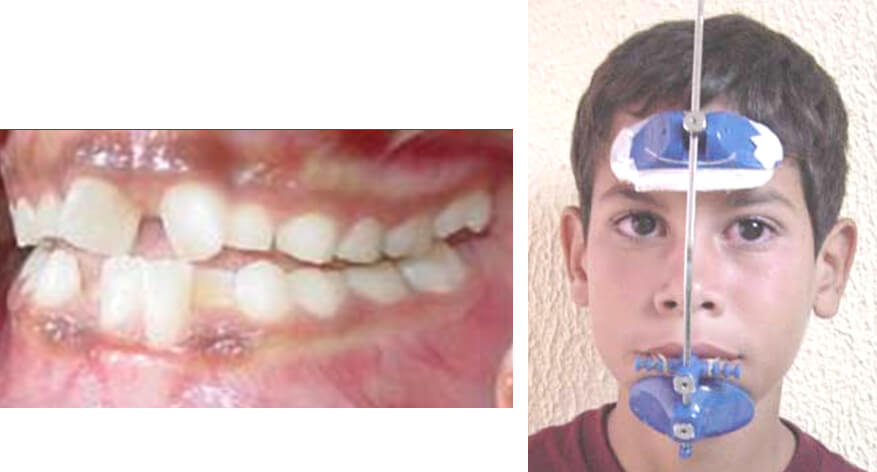 Fig. 1 Tratamiento de la maloclusión Clase III con máscara facial. Primera fase del tratamiento