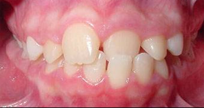 Fig. 3. Vista de frente de mordida cruzada anterior secundaria a una relación dentoalveolar anómala.