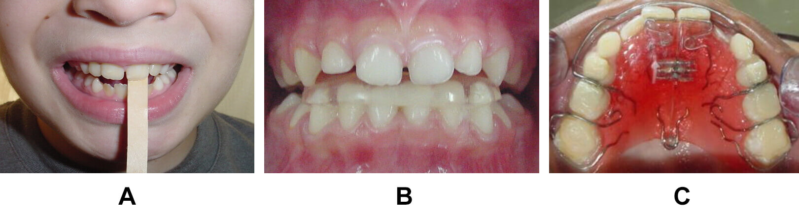 Fig. 4 Diferentes alternativas de tratamiento: a) paleta de madera, b) planos inclinados fijos, c) placa acrílica activa