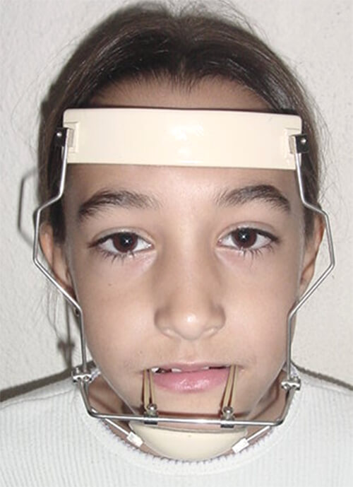 Fig. 5 tratamiento con máscara facial