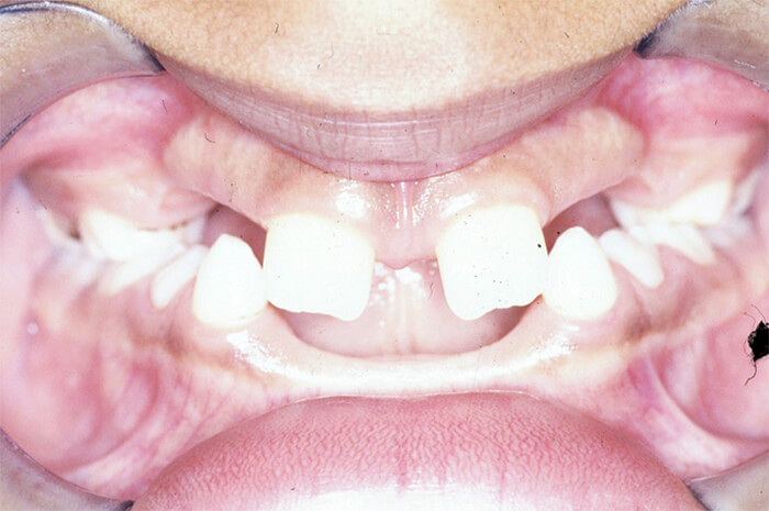 Fig. 2 Vista frontal intraoral, observe la maloclusión (aumento de overbite) por perdida de la dimensión vertical.