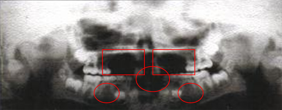 Fig. 3 Examen Radiográfico, donde se observa la ausencia de más de 6 dientes clasificando esta agenesia como una oligodoncia.