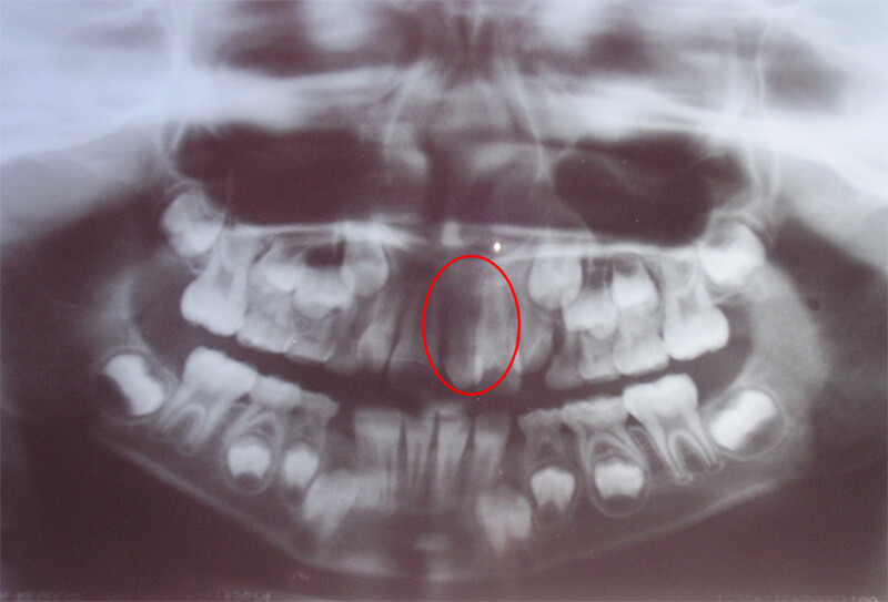 Fig. 5 Examen radiográfico, donde se observa el diente supernumerario (mesiodens) en la premaxila a nivel de la línea media.