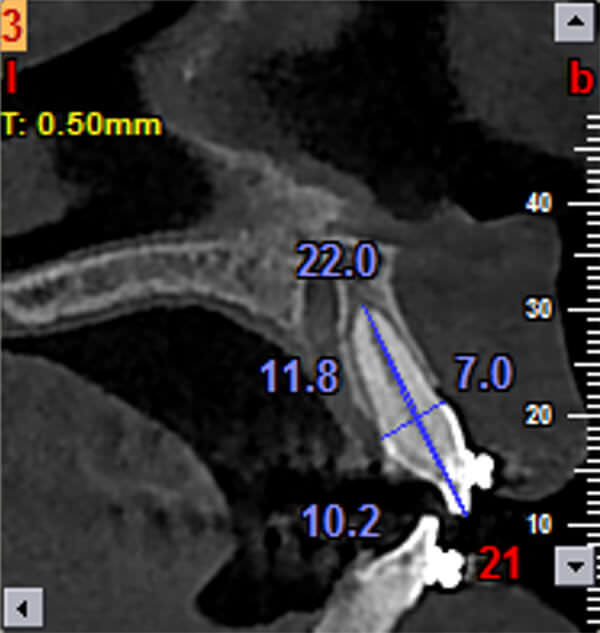 C Figura 1. Imágenes obtenidas del tomógrafo (NewTom VGi Cone Beam 3D Imaging), pertenecientes a la niña Jhoselyn Velez paciente de Posgrado de la II Cohorte de la especialidad de Ortodoncia de la Universidad de Cuenca. A, Imagen Axial. B, Imagen sagital de pieza dental 21 antes de iniciar el tratamiento de Ortodoncia. C, Imagen sagital Pieza 21 después de 6 meses iniciado el tratamiento de Ortodoncia.