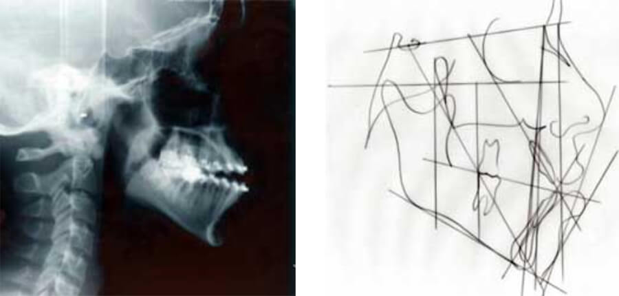 Radiografía Cefálica Lateral y Trazado Cefalométrico Prequirúrgicos.