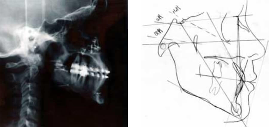 Radiografía Cefálica Lateral y Trazado Cefalométrico Post-quirúrgicos.