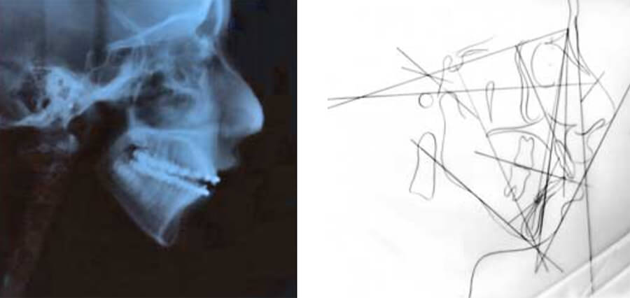 Radiografía Cefálica Lateral y Trazado Cefalométrico Prequirúrgicos.