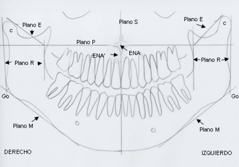 Fig. 2 Paciente femenino de 18 años de edad con Mordida Cruzada Posterior Unilateral