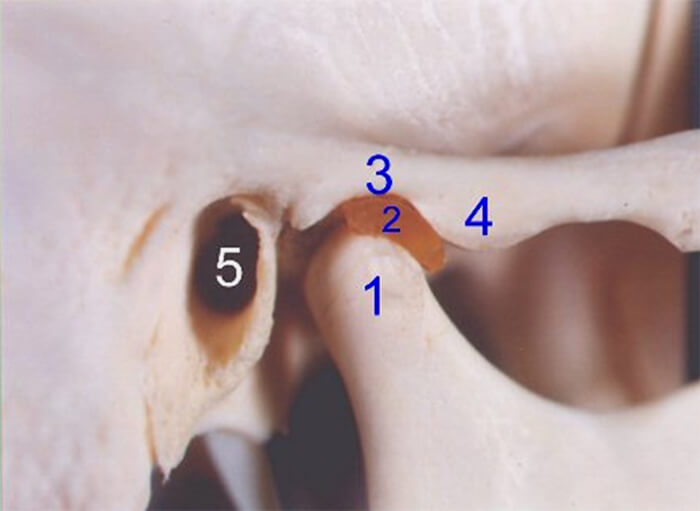 Figura 1 Muestra estructuras anatómicas de la articulación temporomandibular. 1-Cóndilo mandibular, 2.-Disco articular, 3. -Cavidad glenoidea, 4.- Cóndilo del temporal, 5.-Conducto auditivo externo.