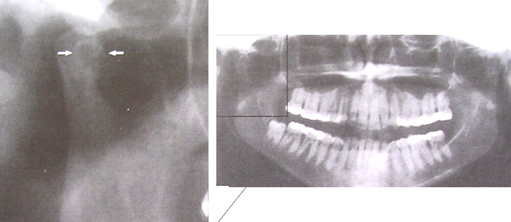 Figura 2. Cambios osteofíticos en el cóndilo mandibular,vista por medio de radiografía panorámica, ISBERG, ANNIKA. Disfunción de la articulación temporomandibular ,una guía práctica.