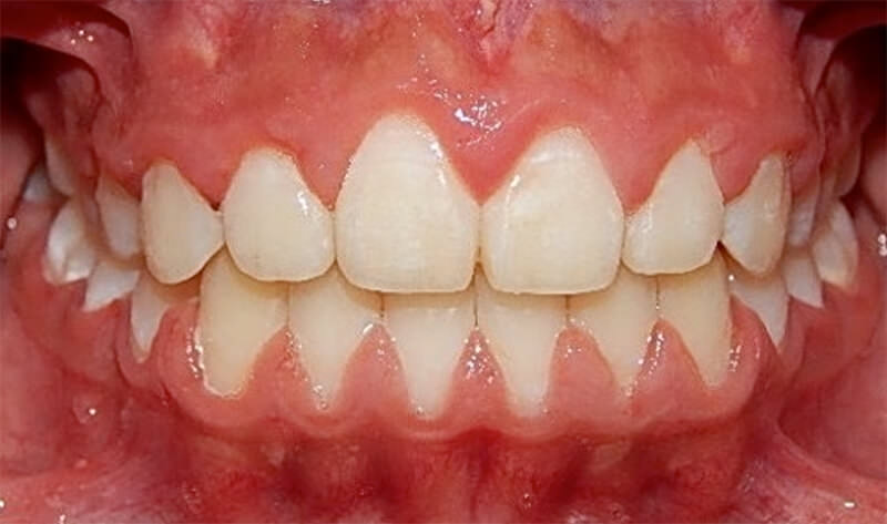 Figura 25b. Comparación final, foto intraoral de frente