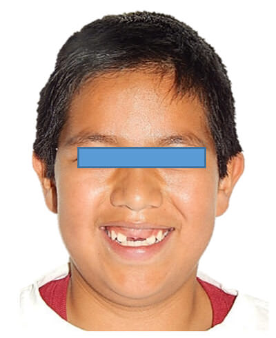 Fig. 2 extraoral de frente