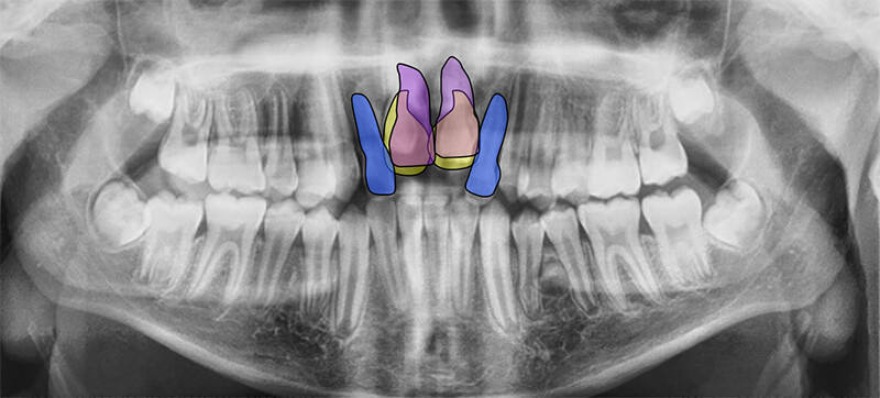 Figura 6. Radiografía panorámica nos muestra delimitado en color azul a los incisivos; el color morado, a los incisivos centrales retenidos, en amarillo gota los dientes supernumerarios.