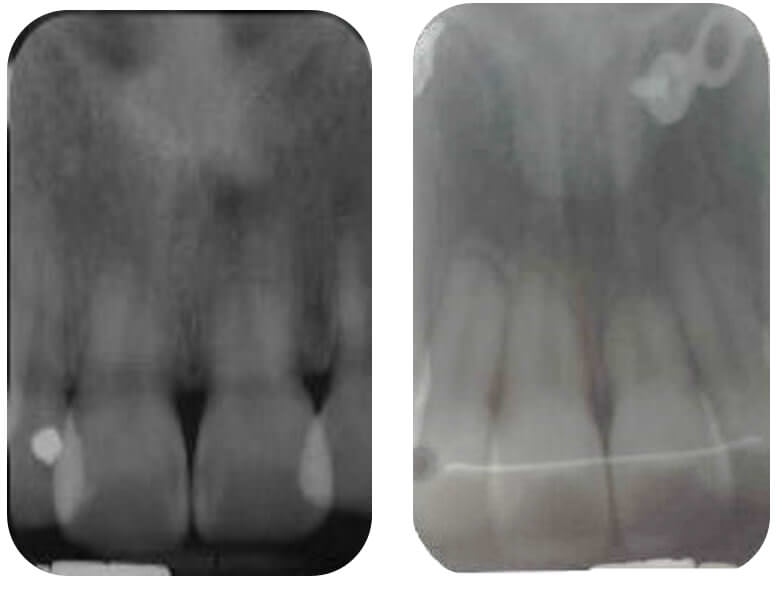 Fig. 26 Rx. Periapical inicio final
