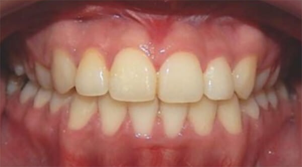Fig. 27 comparaciones inicio y final intraoral de frente
