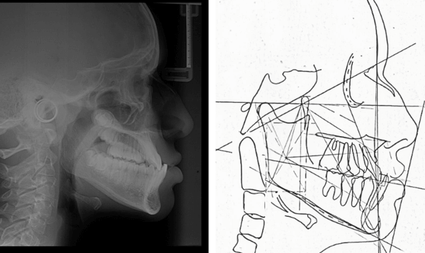 Cefalometría Lateral Inicial