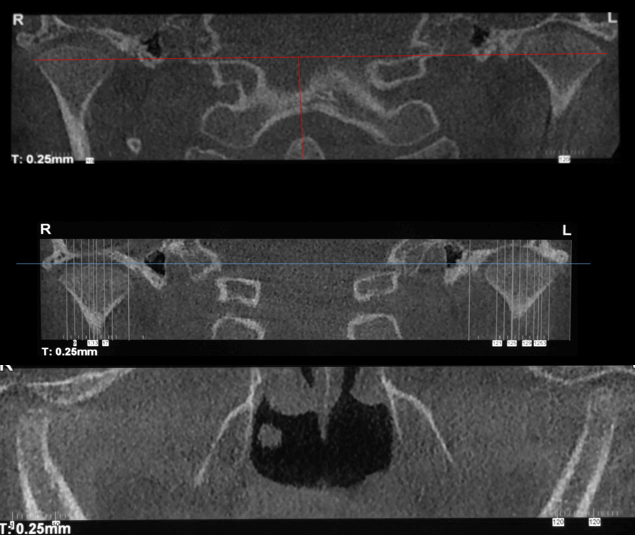 Tomografía Cone Beam Inicial