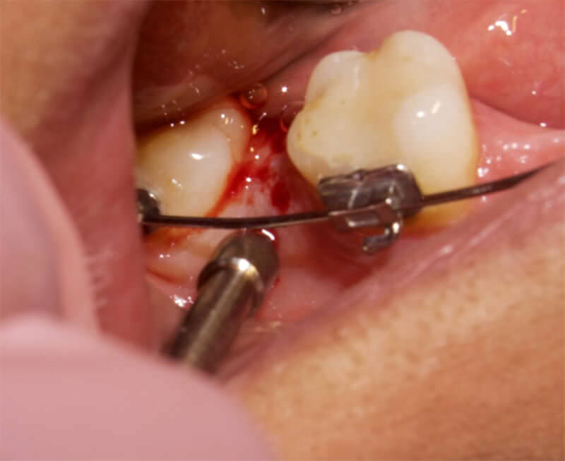 Fig. 3 Estudios previos han demostrado que la realización de micro-osteoperforaciones (MOP) en el hueso alveolar durante el movimiento dental ortodóncico puede estimular la expresión de los marcadores inflamatorios, lo que lleva al aumento de la actividad de los osteoclastos y la velocidad de movimiento de los dientes. Cortesía de la Doctora Claudia Razo Lira.