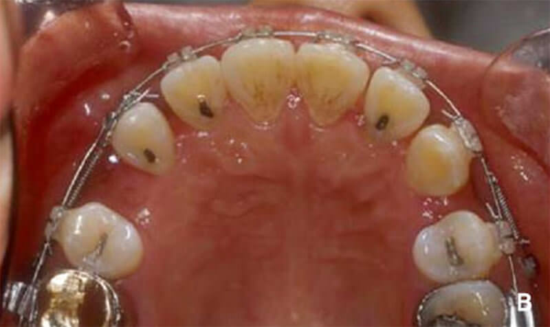 Fig. 5 B. 4 semanas después Fig. 5 Vista oclusal. Fotografía oclusal Cortesía del Doctor Young Guk Park